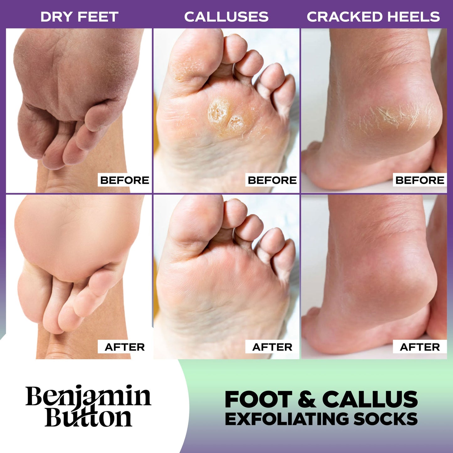 Exfoliating Foot Peel Mask – AHA Foot Peeling Mask – 5 Pack