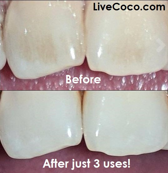 LiveCoco Teeth Cleaning Powder (Vitamins & Aloe Vera Infused)