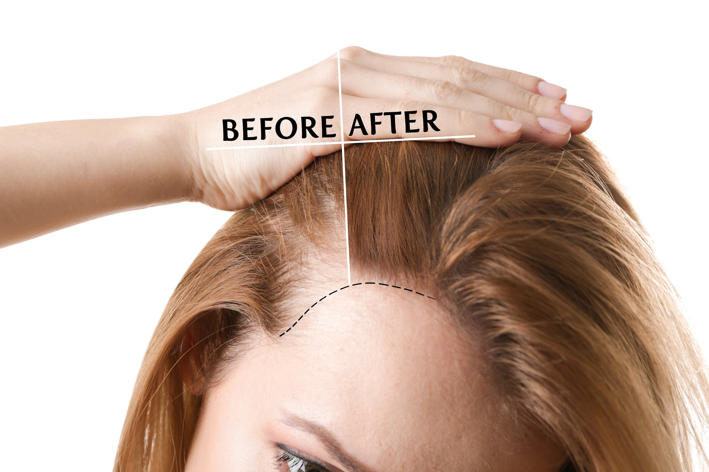 SOS Hair Loss Spray - We Have a Solution !!!